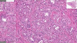 Prostatic Adenocarcinoma  Histopathology [upl. by Yeta86]