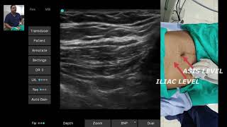 ULTRASOUND GUIDED ILIOINGUINAL amp ILIOHYPOGASTRIC NERVES SONOANATOMY [upl. by Eirek]