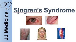 Sjogren’s Syndrome quotDry Eye Syndromequot  Primary vs Secondary Symptoms Diagnosis and Treatment [upl. by Nimrac]