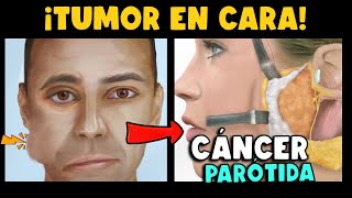 ¡CUIDADO ¿TUMOR EN CARA ¿ASIMETRÍA FACIAL ¿QUÉ ES EL CÁNCER DE PARÓTIDA [upl. by Bullion]