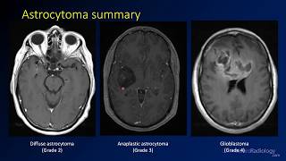 Imaging brain tumors  2  Astrocytomas [upl. by Ailisab]