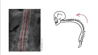 Video 188 Seronegative Spondyloarthritis Psoriatic Arthritis Ankylosing Spondylitis amp More [upl. by Warms957]