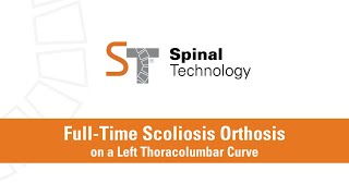 FullTime Scoliosis Orthosis on a Thoracolumbar Curve [upl. by Ogden]