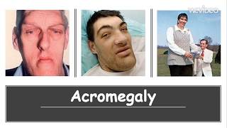 Acromegaly   Causes Diagnosis Symptoms Treatment Prognosis [upl. by Anel483]