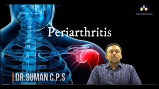 What is PERIARTHRITIS – SHOULDER PAIN What are its Remedies  by DrSuman CPS VGM Hospital [upl. by Dympha]