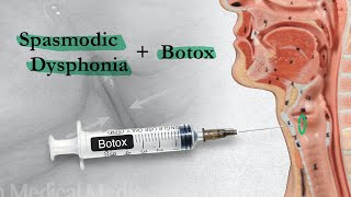 Spasmodic Dysphonia  When Botox Disappoints  Part 2 [upl. by Anowahs375]