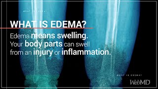 What is Edema  WebMD [upl. by Aldwon]