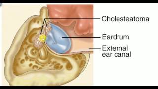 ENT LECTURES  Diseases of Middle Ear  CSOM Fast Revision [upl. by Ellenahs576]