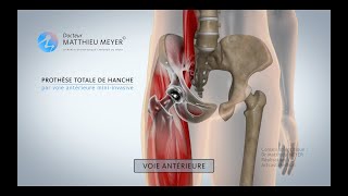 PROTHÈSE TOTALE DE HANCHE PAR VOIE ANTÉRIEURE MINIINVASIVE  DR MATTHIEU MEYER [upl. by Esac]