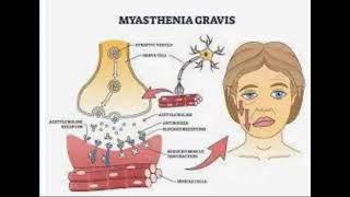 Myasthenia Gravis [upl. by Aliber]