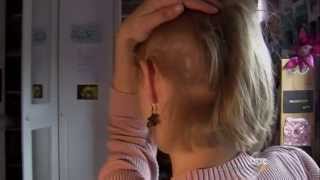 Trichotillomania Why These Women Rip Out Their Own Hair [upl. by Amsaj]