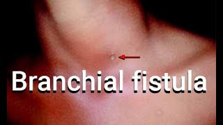 Embryological basis for Branchial Fistula Cleft [upl. by Akimak]