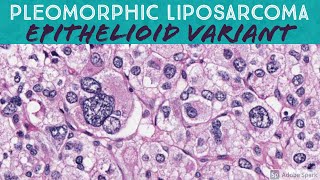 Pleomorphic Liposarcoma Epithelioid Variant [upl. by Finlay1]