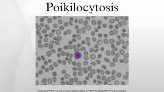 Poikilocytosis [upl. by Annoyk]