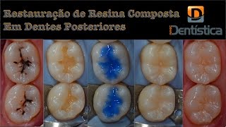 Restauração de resina composta em dente posterior [upl. by Icyak]