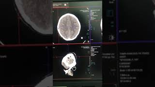 Ct scan of Brain Siemens somatom gotop anatomy [upl. by Yasmar]