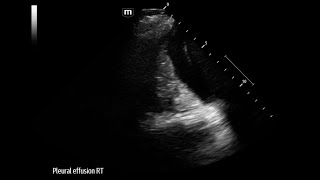 Parapneumomic Effusion Group A Strep Pyogenes Sepsis [upl. by Ilat37]