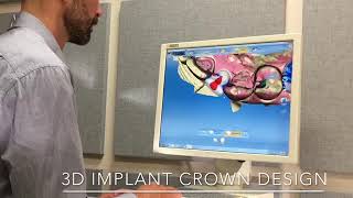 3D Implant Crown design Cerec Blue Cam [upl. by Madelle]