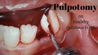 Pulpotomy on healthy Deciduous teeth [upl. by Magna570]