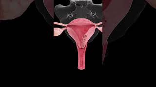 🎗️ Understanding Endometrial Cancer A Growing Concern for Women’s Health 🎗️ [upl. by Nevear]