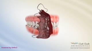 Hawley Retainer  Orthodontic Device [upl. by Jeromy]