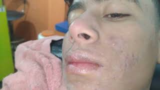 sac be spa blackheads elderly 2025  sac be spa old age blackheads 2024  sac be spa face video new [upl. by Homere]