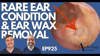 RARE EAR CONDITION amp EAR WAX REMOVAL  EP925 [upl. by Neelrad]