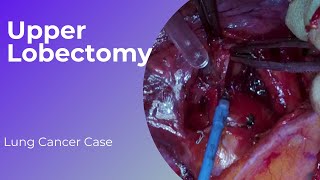 Right Upper Lobectomy 22 [upl. by Oriole]