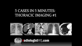 5 Cases in 5 Minutes Thoracic 1 [upl. by Sirap200]