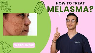 Melasma Treatment and Cure  laser treatment  Home Treatment  Dr Ankur Sarin [upl. by Parish]