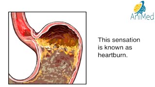 How Heartburn Works Animation Acid Reflux Disease Symptoms Causes amp Treatments Video GERD Explained [upl. by Claus124]