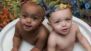 These Twins With Different Skin Colors Are ‘1 In A Million’ – Here They Are All Grown Up [upl. by Edylc]