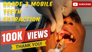 Quick and Painless Extracting Grade 3 Mobile Teeth with Ease viralvideo youtubevideo dental [upl. by Marcell]