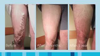 VenaSeal Patient Testimonial  Vein treatment by cyanoacrylate medical adhesive or glue [upl. by Edivad]