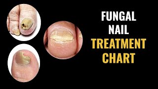 Fungal Nail Treatment Options Chart [upl. by Erkan]