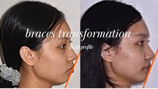 Braces Transformation  Before and After 牙套前后 [upl. by Jermaine398]