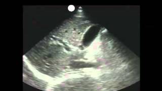 How To Gallbladder Ultrasound Part 1  Introduction Case Study Video [upl. by Ryan]