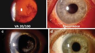 Endophthalmitis Diagnosis Clinical Approach [upl. by Emarej]