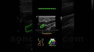 Duplex Sonography  Mild Stenosis Of The Internal Carotid Artery [upl. by Neehsuan]