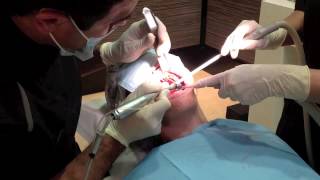 IMPLANTES Y DIENTES FIJOS EN 1 SESION [upl. by Atela]