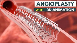 Angioplasty Procedure Explained How It Saves Lives  What Is Angioplasty StepbyStep Explanation [upl. by Onairotciv]