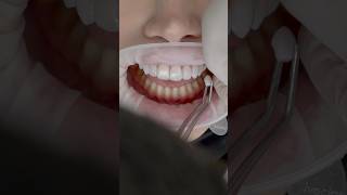 Incredible transformation with Porcelain Veneers Dentalveneers asmr cosmeticdentistry [upl. by Sobel]