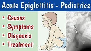 Acute Epiglottitis In Children Causes Clinical features Diagnosis and Management [upl. by Ititrefen]