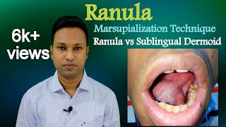 Ranula। How to Marsupialize। Ranula vs Sublingual Dermoid [upl. by Hime]