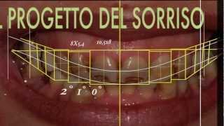 Cambiare laspetto del sorriso con faccette dentali  SMILE DESIGN [upl. by Eilyk161]