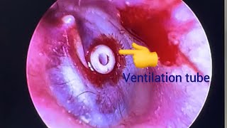 Ventilation tube insertion Part2 [upl. by Koral]