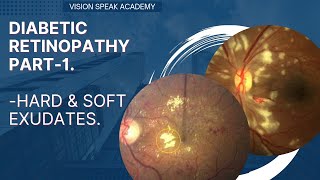 Diabetic Retinopathy 1  Hard amp Soft Exudates [upl. by Ninerb]