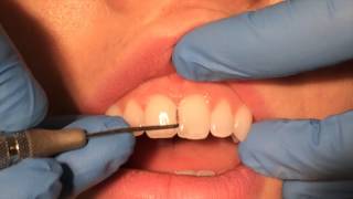 Periodontal Probing [upl. by Filiano]