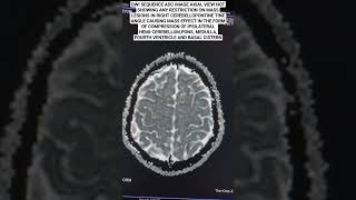 MRI Brain DWI Sequence ADC ImageBrain Pathology mri radiology beginners [upl. by Jehial]