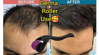 How Many Times Derma Roller can be used  Derma Roller Hair Regrowth  Microneedle At Home [upl. by Ruthanne396]